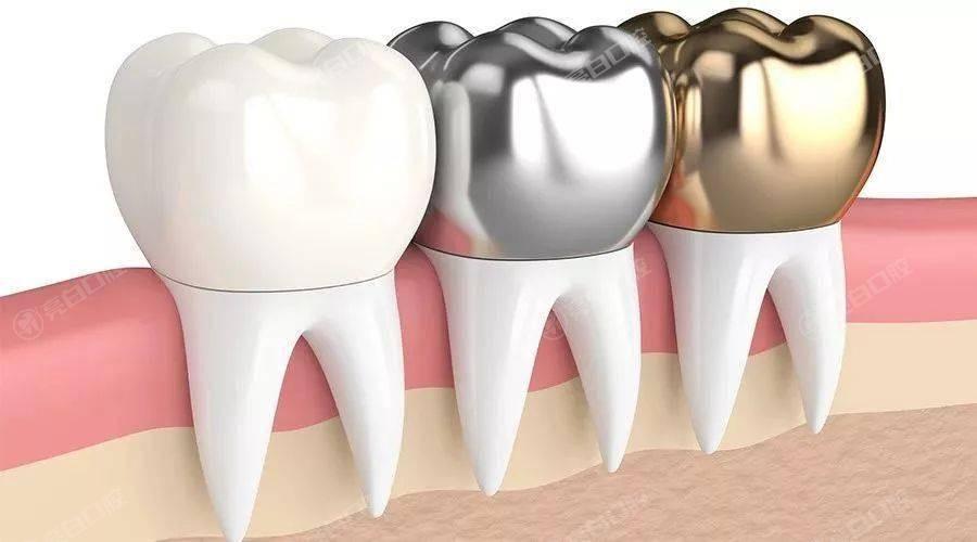 根管治療是什么？有哪些注意事項？